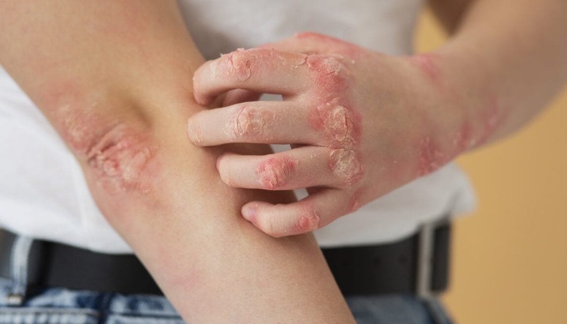 Does my child have eczema?